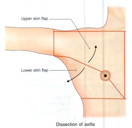 axilla-incision.jpg