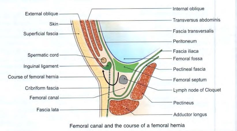 femoral-canal-hernia-course.jpg