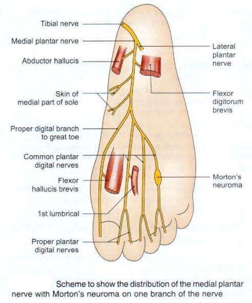 plantar-nerve-medial-schema.jpg