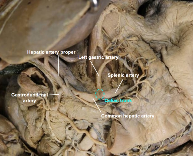 celiac-trunk-cadaver.jpg