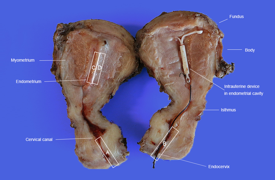 uterus_internal.jpg