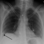 lung-220px-hamptonshump.png