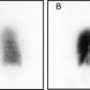 lung-220px-pulmonary_embolism_scintigraphy_plos.png
