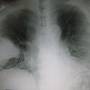 lung-300px-pneumoniswedge09.jpg