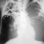 lung-300px-tuberculosis-x-ray-1.jpg