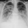 lung-angel_wing-pulmonary_edema1-aemc.jpg