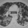 lung-crazy_paving_alveolar_proteinosis.jpg
