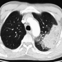 lung-mrsapneumoct.png