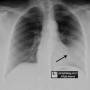 lung-silhouette_sign-lingular_pneumonia-pa.jpg