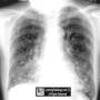 lung-snowstorm-mets_thyroid_ca-1.jpg