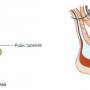 femoral-hernia.jpg