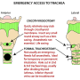 larynx-tracheostomy.png