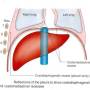 pleural-recess.jpg