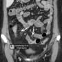 abd-comb_sign-crohns-ct_enterography-2.jpg