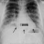 abd-continuous_diaphragm_pneumomediastinum.jpg