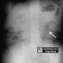 abd-sentinel_loop-pancreatitis--upright.jpg