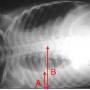 lung-220px-pleural_effusion.jpg