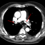 lung-300px-saddlepe.png