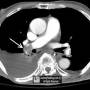 lung-knuckle_sign-axial_ct.jpg