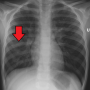 lung-rtpneukidmark.png