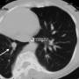 lung-scimitar-ct2.jpg