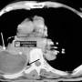 lung-split_pleura_sign-ct-2.jpg