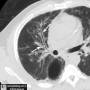 lung-tram-track-bronchiectasis-ct.jpg